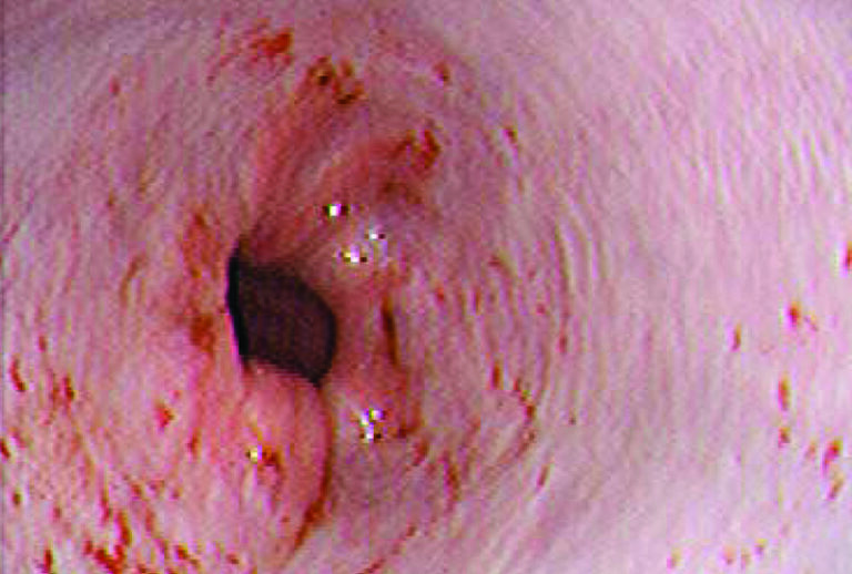 Overview of Upper Gastrointestinal Endoscopy