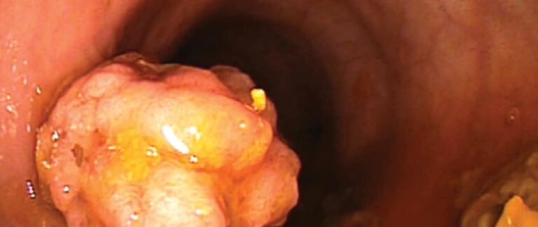Lower Gastrointestinal Endoscopy Series, Part 1: Overview of Lower Gastrointestinal Endoscopy