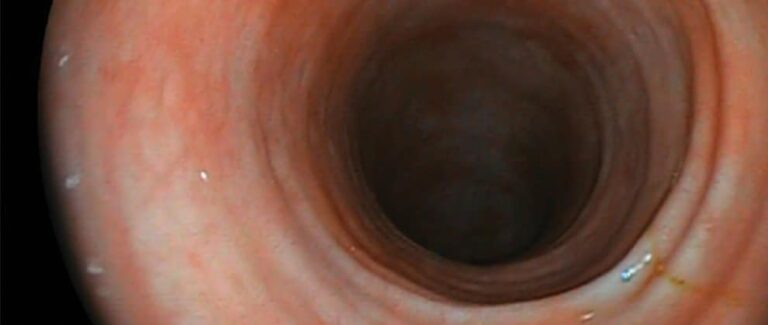 Lower Gastrointestinal Endoscopy Series, Part 2: Lower Gastrointestinal Endoscopy Techniques