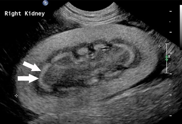 Ultrasonography of the Urinary Tract Kidneys and Ureters Today's