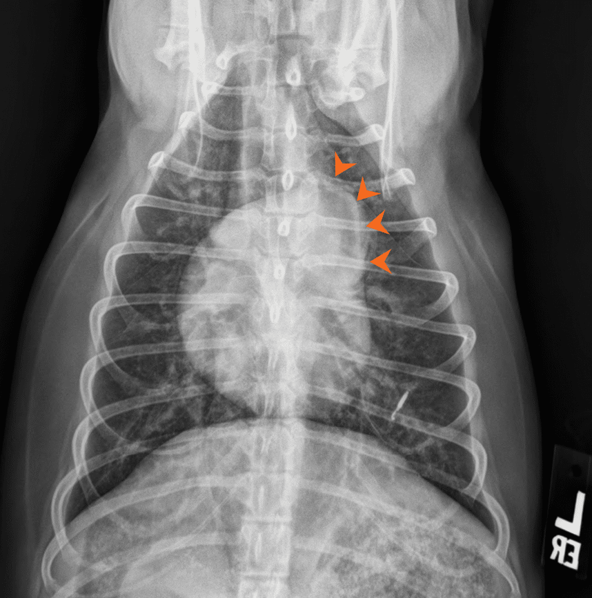 Pulmonary Hypertension Xray Pulmonary Hypertension Xray
